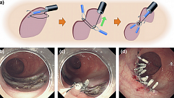 МЕТОДЫ ЭНДОСКОПИЧЕСКОГО ЗАКРЫТИЯ ДЕФЕКТА ПОСЛЕ РЕЗЕКЦИИ СЛИЗИСТОЙ МЕТОДОМ ДИССЕКЦИИ В ПОДСЛИЗИСТОМ СЛОЕ ESD